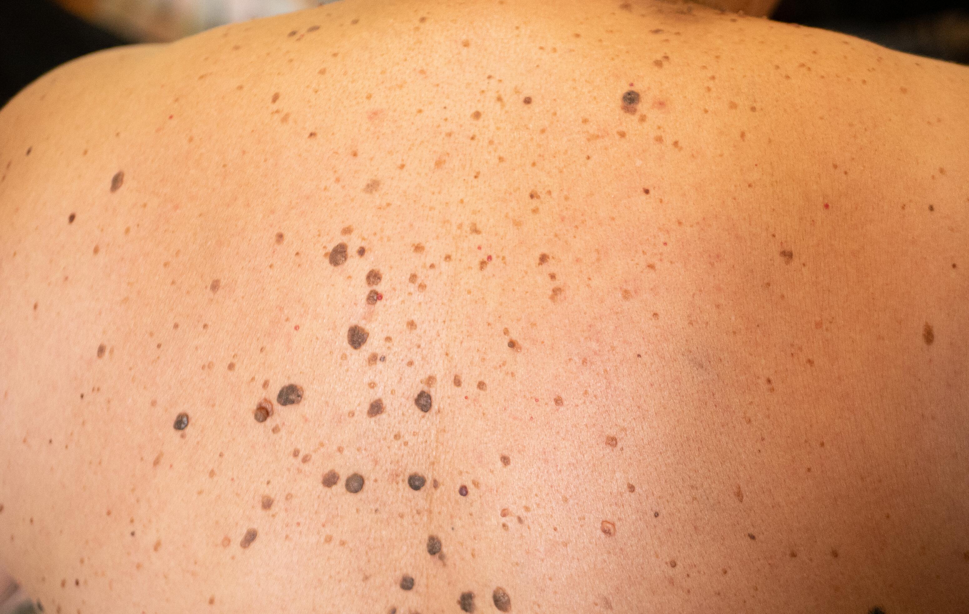 homeopathie tegen seborroïsche dermatitis
